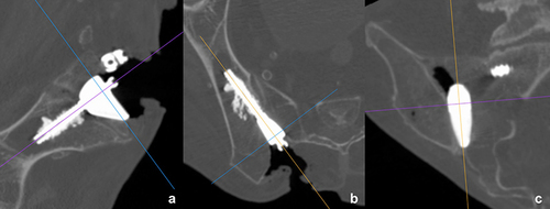 Figure 5 (a and b) Cement augmentation of the iliac screw. Since the implant body is to be anchored in the recess with a screw at the S2 level in the ilium, the average angle formed between the recess and the body of the iliac bone was determined in both (a) the parasagittal (b) and paraxial CT reconstructions; (c) paracoronal reconstruction (cadaver model).