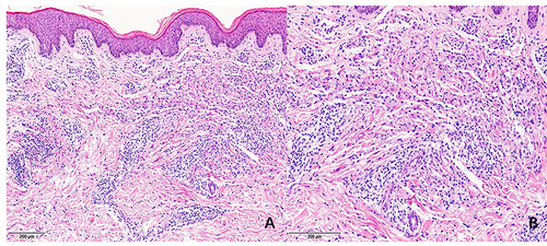 Figure 2 Histopathology: approximately normal epidermis, but diffuse interstitial and perivascular histiocytic infiltrates with scattered neutrophils, nuclear dust, and eosinophils. (A) hematoxylin-eosin x40. (B) hematoxylin-eosin x100.