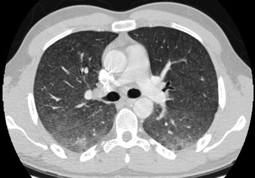 Figure 3. Radiographic presentation of the hypersensitivity pneumonitis form of NTMPD. Diffuse infiltrates with prominent nodularity are visible throughout all lung fields. HRCT image kindly provided by Dr H. Fjallbrant, Sahlgrenska University Hospital, Gothenburg, Sweden.