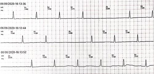 Figure 2 Admitted ECG showed significant sinus bradycardia and sinoatrial block.