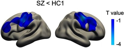 Figure 2 Cortical statistical maps displaying local gyrification index (LGI) reduction in patients with schizophrenia (SZ) compared with young healthy controls (HC1). Monte Carlo cluster simulation was used for multiple comparison correction with a threshold of P<0.05. The colour bar indicates T values.