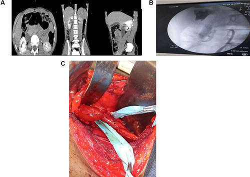 Figure 2 (A) Abdominopelvic CT-scan – axial, sagittal and coronal section. (B) Retrograde pyelography showing the S-shaped retrocaval ureter. (C) Intraoperative image of retrocaval ureter.