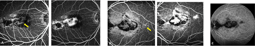 Figure 2. (A) (B) FA OD demonstrated hyperfluorescence in the early frames and late frames of CNV (yellow arrows). Note the fibroglial scars have constant hyperfluorescence. Late frame ICGA in OS (C), revealed numerous hypofluorescent spots corresponding to choroidal nodules.