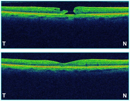 Figure 1 OCT of stage 3 macular hole of the right eye in a 61-year-old patient. Preoperatively (top) and postoperatively, after removal of silicone oil (bottom).