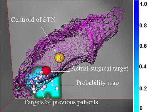 Figure 3. Segmented sub-thalamic nucleus (STN) registered with AtamaiWarp. The mesh object is the STN. The yellow sphere is the centroid of the STN, the red sphere is the actual surgical target, and the white spheres represent surgical targets of previous patients. The color-coded map is the probability map of a collection of left STN DBS targets. [Color version available online.]