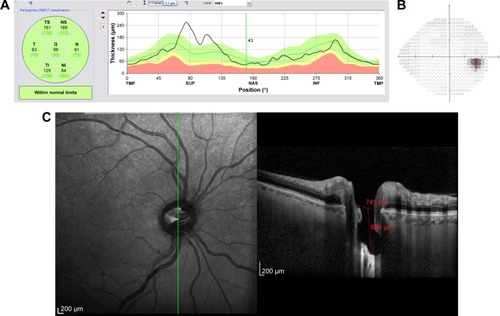 Figure 10 Structural and functional findings in a glaucomatous eye in percentile group 2 of the HVOC (mean =1,128 µm, mean MD =−5.10 (1.0) dB). (A) Circumpapillary RNFLT; (B) standard automated perimetry grayscale map; (C) B-scan of the largest vertical optic disc cup and length and depth used to calculate the HVOC.