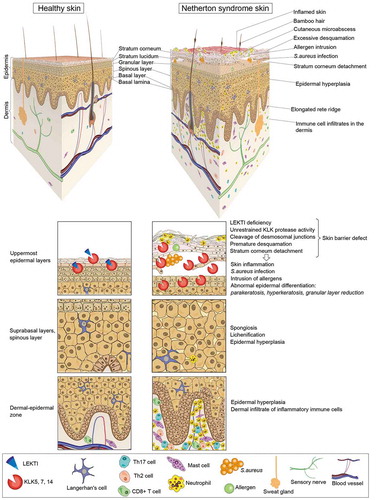 Figure 3. Cellular and histopathological hallmarks of NS patient skin. Schematic representation of NS patient skin in comparison to healthy skin. The skin of NS patients is often red (a sign of ongoing skin inflammation). Hairs are sparse and, when present, are short, fragile or broken. A typical hair defect in NS patients is the ‘bamboo’ hair in which the distal part of the hair invaginates into its proximal part (trichorrhexis invaginata). In the absence of LEKTI, kallikrein-related peptidases (KLKs) secreted by the cells of the upper granular layer uncontrollably degrade corneodesmosin, corneodesmosomal cadherins, filaggrin and lipid processing enzymes, thus leading to premature desquamation and stratum corneum detachment. In parallel, unrestrained activity of epidermal serine proteases activates a cascade of pro-inflammatory signals independent of the skin barrier defect and environmental factors. The barrier defect together with these intrinsic inflammation signals result in major pathologic changes of NS patient skin such as abnormal keratinocyte differentiation, skin infections and chronic skin inflammation. Signs of abnormal differentiation are parakeratosis (retention of nuclei in the stratum corneum), altered lamellar body secretion in the stratum corneum resulting in abnormal or absent lamellar lipid layers and partial or complete lack of granular layer with loss of keratohyalin granules. These features are associated with epidermal hyperplasia, elongation of rete ridges, and spongiosis (expanded intercellular spaces between spinous layer keratinocytes due to intercellular oedema). Defective epidermal barrier facilitates bacterial infections and allergen penetration through the skin. This results in skin inflammation mediated by protease activity and cytokine signaling cascades in the epidermis and recruitment of immune cell infiltrates mainly consisting in mast cells, neutrophils, Th17 and Th2 cells
