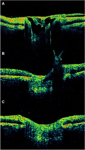 Figure 38 Stratus optical coherence tomography can determine the vitreous state.