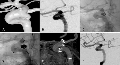 Figure 1 The EP2 stent markers were asymmetrical in proximal parent artery. (A) the 3D reconstruction diagram of aneurysm at the right paraclinoid aneurysms; (B) the result of intraoperative at right paraclinoid aneurysms; (C) the process of EP2 stent (23mm) were released intraoperation; (D) the result of EP2 stent were released post-operation, the proximal markers were asymmetrical and the distal markers were symmetrical; (E) sagittal view of the stent in Dyna-CT; (F) the follow-up result of stent-assisted treatment for paraclinoid aneurysms.