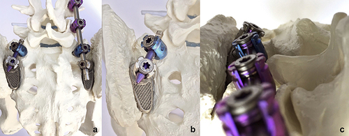Figure 7 Trials of the printed titanium implants with diamond lattice structure on a solid plastic model. (a) On the left side, the patient-matched implant is used as a SIJF. On the right side, it contributes to the primary stabilization of the lumbar spine, sacrum and pelvis because it is fully integrated into the stabilization system. (b) Enlarged view of the application as a SIJF. (c) Pedicle screw heads in line with the implant screw tulip. The anatomy favors this patient-specific stabilization system.