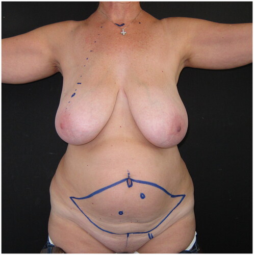 Figure 1. Pre-operative drawings of the skin island of the DIEP flap and the selected left-side perforator, for immediate reconstruction following the planned right breast skin-sparing mastectomy.