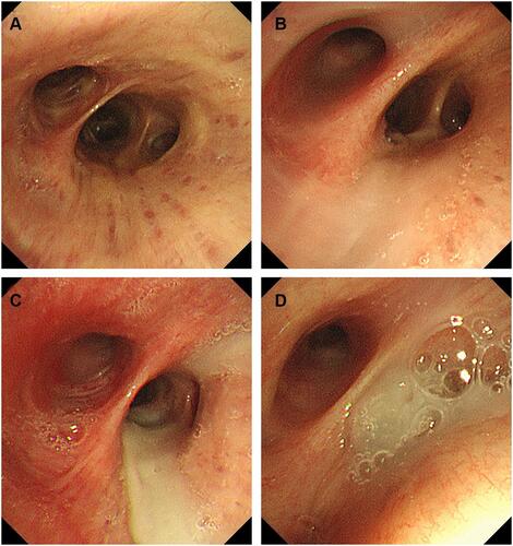 Figure 2 Bronchoscopic findings at the bronchial entrances of the right middle and lower lobe showing the luminal mucus scoring. (A) Score 0, normal; (B) score 1, strands of clear mucus; (C) score 2, globules of mucus; (D) score 3, airway occluded.