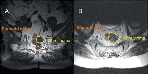 Figure 1. November 2003. A transverse T2-weighted magnetic resonance imaging (MRI) picture (A) and a coronal T1-weighted one (B), showing a fairly well-circumscribed tumour, measuring about 3 × 3 × 3 cm, located in the soft tissue ventrally to the sacrum, with overgrowth on the peripheral parts of the wall of the rectum. No tumour-like lesions occurred in the sacrum, neither in the coccyx, nor in the cauda equina.