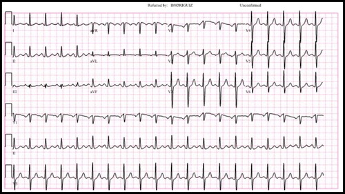 Figure 1. The patient’s electrocardiogram on presentation, showing normal sinus rhythm with sinus tachycardia.