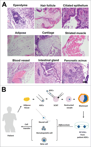 Figure 5. Pluripotency of the NT-ESCs in vivo. (A) Teratoma formation assays indicated NT-ESCs injected under the skin of nude mice could differentiate into epidermal, mesodermal and endodermal layer cells. These epidermal layer cells included ependymal cells in brain ventricle-like tissue, hair follicle in skin-like tissue and ciliated epithelial cells in respiratory epithelial-like tissue. The mesodermal layer cells contained adipocytes in adipose-like tissue, chondrocytes in cartilage-like tissue, myocytes in striated muscle-like tissue. The endodermal layer cells included endothelial cells in blood vessels, glandular cells in intestinal glands and islet cells in pancreatic glands. (B) Schematic drawing of generation of patient adipose tissue-derived NT-ESCs for therapeutic cloning in the future. By SCNT, patient ADCs can be reprogrammed into NT-ESCs, which can then be induced to any desired, specific type of cells such as neural cells, haematopoietic cells and β cells prior to transplantion in vivo for treatment of various types of diseases. Scale bar in (A), 100 micrometers.