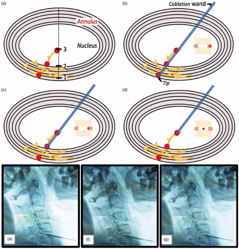 Figure 2. Three distinct ablation regions in the degenerative disc. (a) Mechanoreceptors innervate from annulus into nucleus, 1-plot indicates the margin of annulus, 2-plot indicates the boundary between annulus and nucleus, and 3-plot indicates the mid-nucleus; (b–d) Ablation region is in the margin of the annulus, the boundary between annulus and nucleus, and the mid-nucleus, respectively; (e–g) In C4–5 level, the ablation region is in the margin of the annulus, the boundary between annulus and nucleus, and the mid-nucleus under fluoroscopic guidance, respectively.