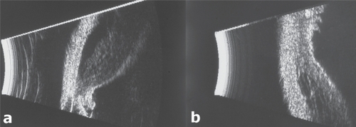 Figure 1 M-scan (Scheimpflug) photography showing shallowing of anterior chamber, angle-closure, and annular cyclitis OS A) compared to OD B).