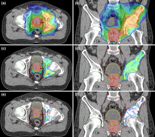 Figure 2. The axial (a, c, e) and coronal (b, d, f) dose distributions of 63-year-old prostate cancer patient with CT+ MR detected metastases in left ilium and acetabulum, and in right parailiac lymph nodes. Pre-treatment PSA was 250 μg/l and Gleason score 9. Patient dose prescription was 45 Gy in 25 fractions (fr) to regional lymph nodes, 50 Gy/25 fr to seminal vesicles and 78 Gy/39 fr to prostate. Bone metastases were treated to 73Gy (45 Gy/25 fr + 28 Gy/14 fr). Dose map ranged from 45 Gy to 78 Gy (a, b), from 69.3 Gy to 78 Gy (c, d) and from 70.1 Gy to 78 Gy (e, f). 1.5 years after the radiation therapy, the PSA was < 0.1 μg/l, the bone metastases were sclerotic, and the lymph node metastasis had shrunk.