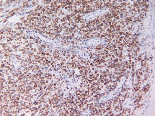 Figure 3.  The neoplastic large B-cells are Bcl2 protein positive (original magnification×200).