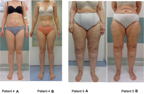 Figure 4 Lower limb photos of two patients (no. 4 and no. 5) with lipedema before and after the MCMF diet. Patient 4 and 5: (A) - photo before intervention; (B) - photo after intervention (own documentation).
