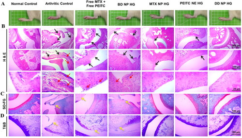 Figure 11. In vivo anti-arthritis efficacy of dual-drug nanoparticles loaded hydrogel. Histopathological assessment of bone destruction and cartilage damage in RA model. (A). In vivo paw images of the rats from different groups at the endpoint, i.e. 33rd day. Histological sections with (B). H&E, (C). SO-FG and (D). TB staining of ankle joints in different treatment groups. The red arrow indicates inflammatory cellular infiltration, and the black arrow represents bone erosion and cartilage degradation. Yellow arrows indicate loss of proteoglycan. Scale bar = 200 μm, 100 μm and 25 μm. H&E: Hematoxylin and eosin; SO-FG: Safranin O-fast green; T&B: Toluidine blue.