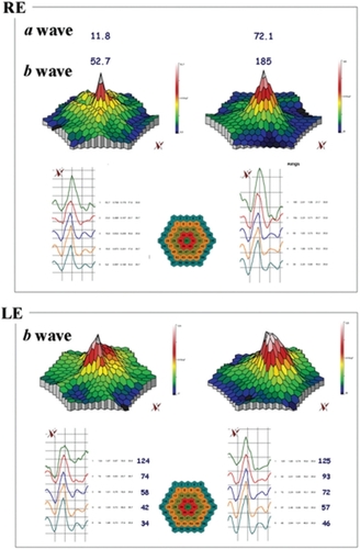 Figure 2 mfERG showing the peaks of a and b waves for case five. In the RE the peaks of the a and b waves respectively increased from 11.8 nV/deg2 (top right panel) to 72.1 nV/deg2 (top left panel) and from 53 nV/deg2 (top right panel) to 185 nV/deg2 (top left panel), after six months. The LE was affected with choroidal neovascularization: it is notable that the four external ring were improved when comparing before (bottom right panel) and after treatment (bottom left panel).
