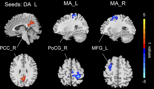 Figure 3 The altered FC in the amygdala subregions of OSA, the increased FC in post-CPAP compared to pre-CPAP OSA (warm color), the decreased FC in post-CPAP compared to pre-CPAP OSA (cold color); Gaussian random field theory (GRF) two-tail corrected with voxel level p < 0.01 and cluster level p < 0.05.