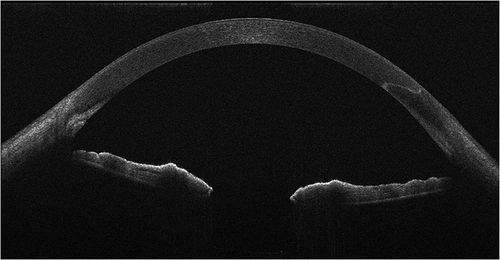 Figure 1 AS- OCT image of 2.2mm clear corneal incision created by the femtosecond laser.