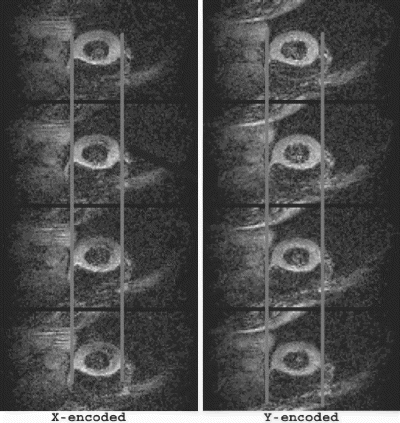 Figure 5. Multiphase DENSE images for freebreathing condition.