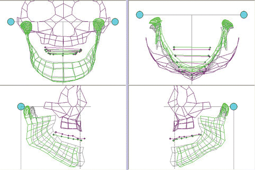 Figure 16. ManMoS simulation with priority given to the skeletal correction. [Color version available online.]