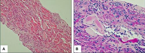 Figure 1 Histology of kidney tissue showing myeloma cast nephropathy. (A) Hematoxylin and eosin stain (magnification ×200). (B) Periodic acid-Schiff stain (magnification ×400).