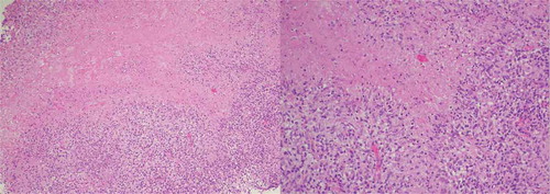 Figure 3. Pleural biopsy showing tuberculosis granuloma with a central caseous necrosis; magnification x100 and x200, respectively)