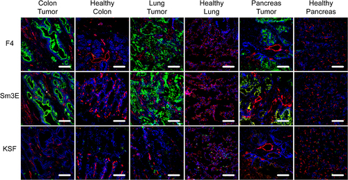 Figure 2. Immunofluorescence analysis of human cancer sections. Human tissue microarrays with cancer sections and corresponding healthy controls were analyzed by immunofluorescence analysis with F4, the positive control Sm3E, and an irrelevant isotype control (KSF). Antibody binding was detected in green. Blood vessels were detected with CD31 staining (red) and nuclei with DAPI (blue). 20× magnification, scale bars = 100 μm.