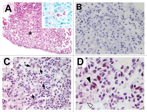 Figure 4. Murine tuberculosis granulomas contain non-macrophage cells undergoing pMLKL driven necroptosis. Mice were infected with M. tuberculosis by intranasal challenge and lung pathology analysed at 21d.p.i. (A) H&E stain. Granulomatous inflammation within the lung with abundant foamy macrophages and small areas of necrosis (asterisk). Original magnification: 100X. Inset shows Ziehl-Neelsen staining revealing numerous acid fast bodies (AFBs) present within the lesion. Original magnification: 400X. (B) Non-immune 1 ͦ antibody isotype control staining for immunohistochemistry. Original magnification: 400X. (C) pMLKL immunohistochemistry. Positive staining within the cytoplasm of elongated cells within the granulomatous inflammation and necrosis. Original magnification: 400X. (D) pMLKL immunohistochemistry. Positive staining is observed predominantly in cells with fusiform-nuclei (black arrow) adjacent to non-immunoreactive foamy macrophages (white arrow) and necrotic cell debris. Original magnification: 400X