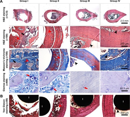 Figure 6 Representative histological images of transverse sections from the middle femur at 4 weeks after implantation.Notes: (A) Decalcified sections without implants with H&E staining, Masson’s trichrome staining, and Giemsa staining. (B) Van Gieson-stained undecalcified sections with implants. The black arrows indicate intracortical abscesses or inflammatory cells; the red arrowheads indicate bone cortex destruction; the red arrows indicate bacteria; and the black arrowheads indicate new bone formation around the implants. Groups I, II, III, and IV indicate Ti + S. aureus, NT + S. aureus, NT-G + S. aureus, and Ti + PBS, respectively. Ti, titanium without modification.Abbreviations: H&E, hematoxylin and eosin; I, implant; NT, nanotubes; NT-G, gentamicin-loaded nanotubes; PBS, phosphate-buffered saline; S. aureus, Staphylococcus aureus.