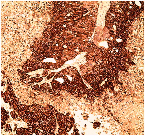Figure 3. Immunohistochemical staining of CA IX expression in a HT-29 tumor.