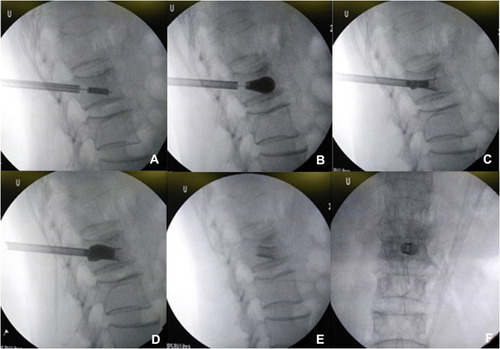 Figure 1 Intraoperative radiological images. (A) Build a working cannula through unilateral pedicle approach. (B) Inflate balloon and push open VBS. (C and D) Adjust the balloon placement and completely push open VBS. (E and F) Remove balloon and inject filler material, then remove working cannula.