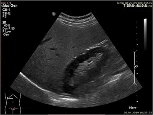 Figure 1 Mild steatosis (S1) bright liver with discrete posterior attenuation.