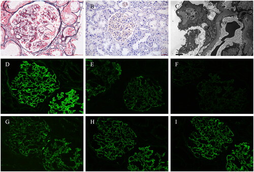 Figure 1. Histologic findings on renal biopsy. (A) Light microscopy showed the glomerular basement membrane thickened diffusely, with the formation of segmental spikes (periodic methenamine silver and Masson trichrome staining, ×400); (B) immunohistochemical staining of phospholipase A2 receptor (×200); (C) electron microscopy showed uniform diffuse thickening of the glomerular basement membrane (830 nm) with the formation of segmental spikes; (D–I) immunofluorescent staining for IgG, IgG1, IgG2, C3, kappa, and lambda granular staining along glomerular basement membrane.