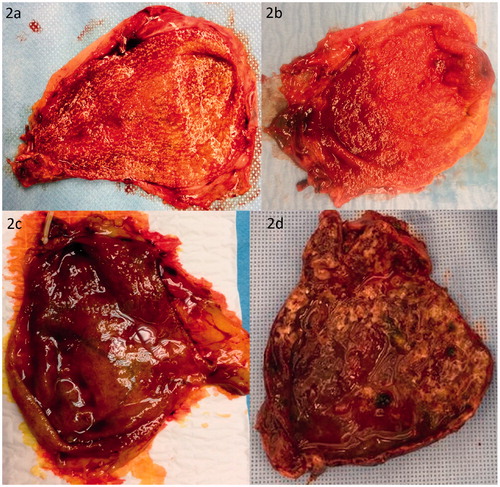 Figure 2. (a, b) Macroscopic images of a normal appearance of the gallbladder mucosa. Please notice the smooth and glistening serosa and folded mucosa. The numerous spots are cholesterolosis, which is accumulation of lipoma filled macrophages in the mucosa. (c, d) Macroscopic image of acute cholecystitis gallbladder.