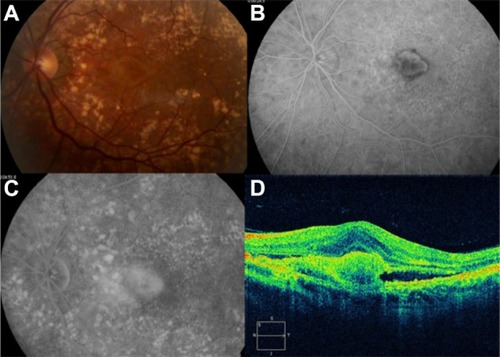 Figure 14 Choroidal neovascularization.