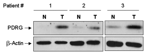 Figure 3 PDRG1 protein is overexpressed in human colon cancer. Representative western blots showing PDRG expression in matching normal and tumor tissues. Protein samples prepared from primary matching normal (N) and tumor (T) tissues were subjected to western blotting using anti-PDRG antibody. Same blots were subsequently probed with anti-β-actin antibody to show loading in each lane.
