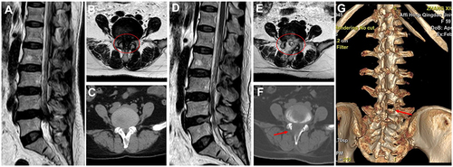 Figure 8 A 59-year female patient diagnosed with CLSS combined with DH at the L4-5 level underwent an Endo-ULBDD. (A–C) Preoperative MRI and CT. The red circle in (B) indicated severe CLSS. (D–F) Postoperative MRI and CT. The red circle in (E) indicated 360° decompression of spinal canal. (F and G) The red arrow indicated that the inferior articular process of L4 vertebra was partly preserved. (A and D) sagittal view; (B and C), (E and F) axial view; G 3 dimensional reconstruction.