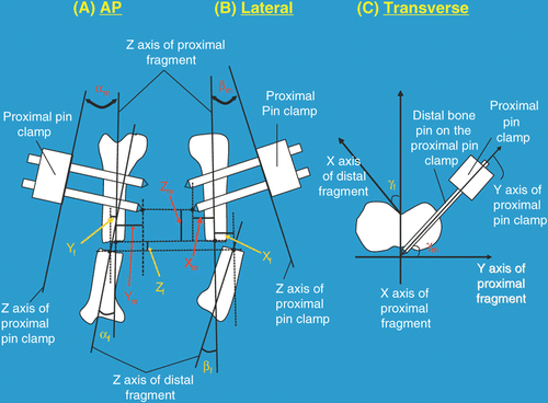 Figure 1. Definitions of the twelve projection parameters. Six parameters (i.e., 3 translations and 3 angulations) are required to quantify the fracture deformity and a further six parameters (i.e., 3 translations and 3 angulations) are required to quantify the spatial relationship between the proximal pin clamp and the proximal fracture fragment. (1) Angulation parameters: Lines are drawn along the longitudinal axes of the proximal and distal fracture fragments on both the AP (A) and lateral (B) X-ray images. The angles between them are the AP view fracture site angulation (αf) and the lateral view fracture site angulation (βf), respectively. Lines are also drawn along the longitudinal edge of the proximal pin clamp on the AP and lateral X-ray images. The angles between the pin clamp line and the proximal fracture fragment line on the AP and lateral view are the AP view mounting angulation (αm) and lateral view mounting angulation (βm), respectively. On the transverse projection photograph (C), the angle between the AP axes of the distal and proximal fracture fragments is the transverse view fracture site angulation (γf). The angle between a line along the distal bone pin of the proximal pin clamp and the lateral axis of the proximal fracture fragment is the rotational mounting offset (γm). With the frontal plane of the proximal tibial fragment positioned parallel to an examination table, the AP and lateral axes of the proximal fracture fragment correspond to vertical and horizontal lines on the transverse photograph. (2) Translation parameters: On both the AP (A) and lateral (B) X-ray images, the origins of each fracture fragment are defined as the centroid of the outline of each fracture end. The three components of fracture site translations (xf, yf, zf) correspond to the x, y, z components of a vector from the origin of the proximal fracture fragment to the origin of the distal fracture fragment in terms of the local coordinate system of the proximal fracture fragment. The origin of the proximal pin clamp is defined as the tip of the distal bone pin of the proximal pin clamp. Hence, the three components of mounting translations (xm, ym, zm) are the x, y, z components of a vector from the origin of the proximal fracture fragment to the origin of the proximal pin clamp in terms of the local coordinate system of the proximal fracture fragment. zf and zm can be measured in both the AP and lateral view.