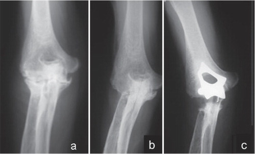Figure 4. a. Rheumatoid elbow of a 65-year-old woman before synovectomy. b. 13 years after the synovectomy. ADL scores were worse 10 years after the synovectomy. TEA was performed due to the recurrence of arthritis 13 years after the synovectomy. The MEPS was 50 points just before the TEA. c. After TEA, the patient experienced relief of the pain with no swelling and disability in ADL. The MEPS was 80 points at the final follow-up examination, 10 years after TEA.