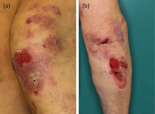 Figure 4. Inflammatory variant of EBA. (a) Erythema, erosions, and crusts on the left knee of a 76-year old patient. (b) Blisters and erosions on the right elbow of the same EBA patient.