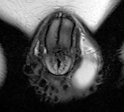 Figure 3 MRI scan, coronal position, T2WI bilateral intra-scrotal nodular shadow with low signal.