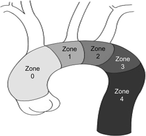 Figure 2 Zones of the aortic arch.