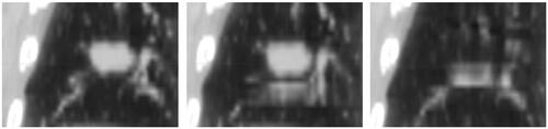 Figure 3. Coronal slice in three different respiration phases of a problematic 4D-CT. The present image artefacts were caused by irregular breathing pattern and were not discovered during the 4D-CT but before planning and treatment. Consequently, the 4D-CBCT was examined closely after the first treatment session.