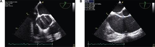 Figure 4 Transesophageal echocardiography (TEE) images show the bicuspid aortic valve A) and the ascending aorta dilatation B).